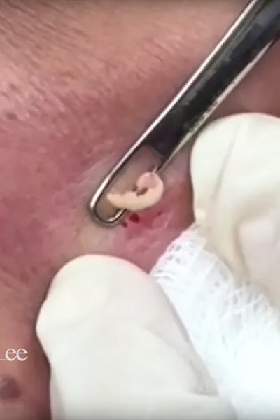Blackhead