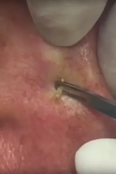 Pores