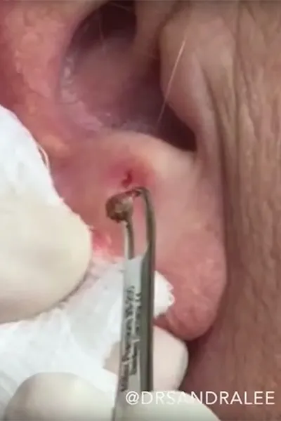 Blackhead