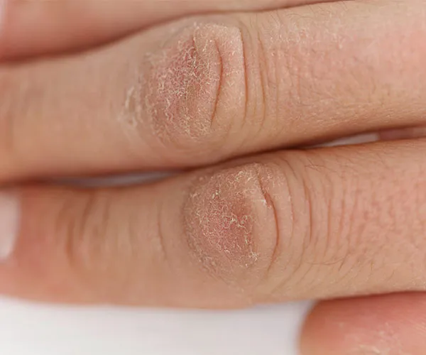 close up dry hands
