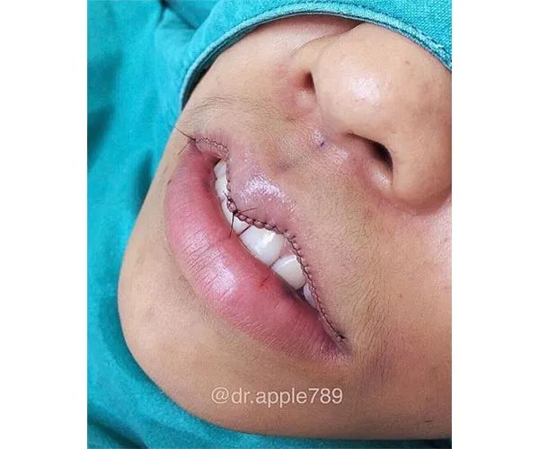 lip reduction surgery