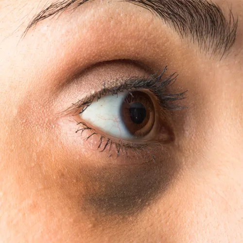 dark circles