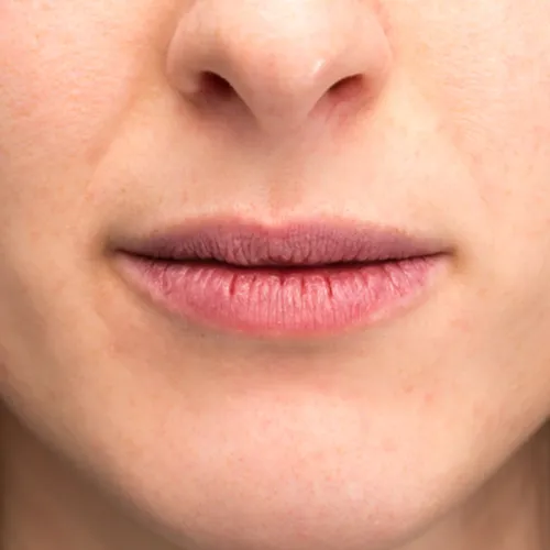 chapped lips