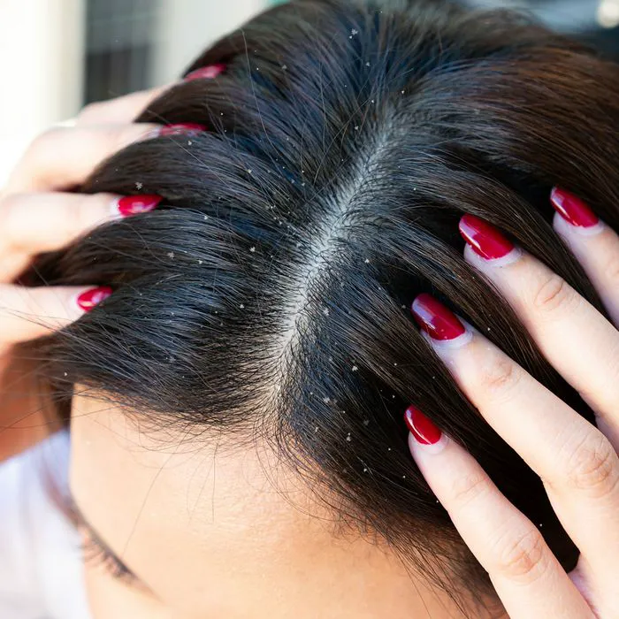 flaky-scalp-dandruff