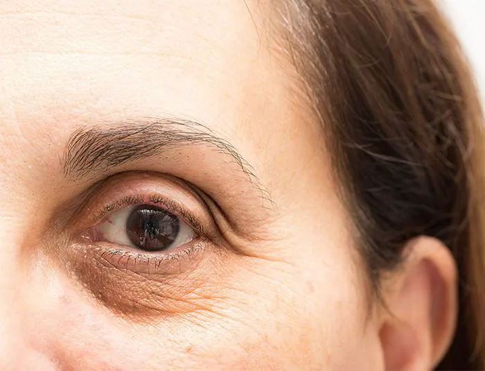 closeup-undereye