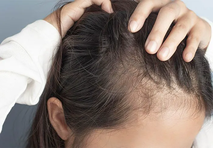 patchy-scalp