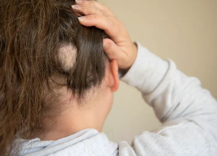 bald-spot