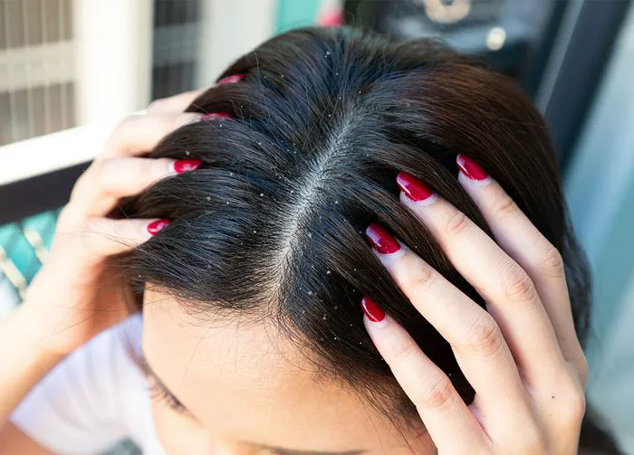 hair-dandruff