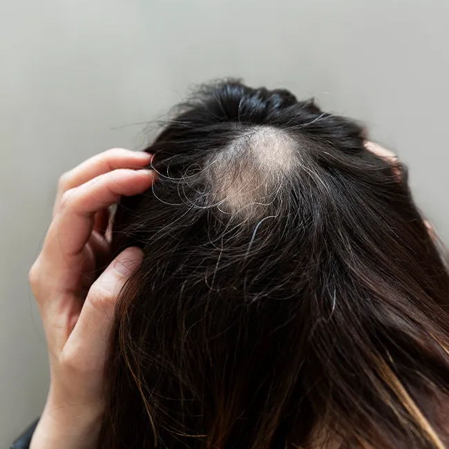 Concerned woman examining her bald spot in mirror.